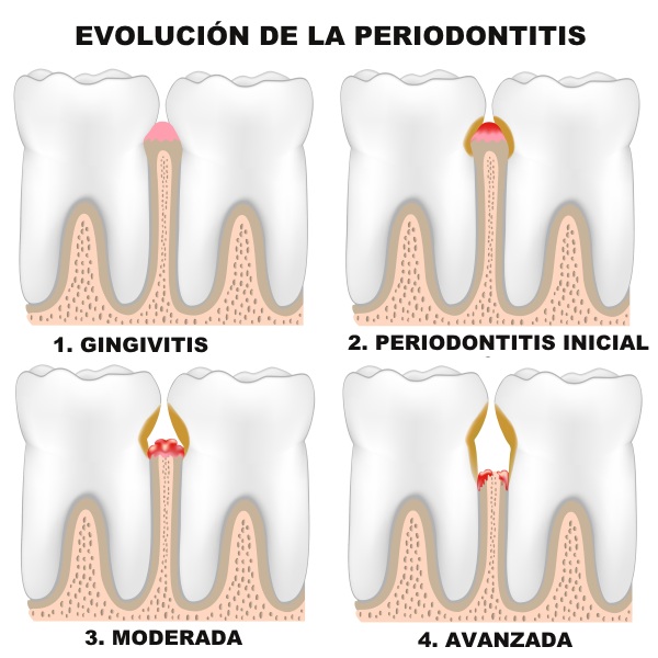 periodoncia